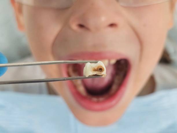 Best Knocked-Out Tooth (Avulsed Tooth) Treatment in Superior, CO
